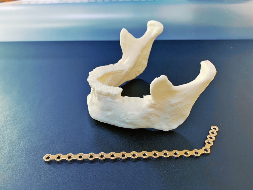 3D-принтер помогает в предоперационной подготовке пациентов с челюстно-лицевыми травмами